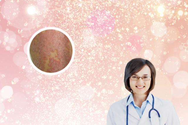 “牛皮癣”你了解多少？